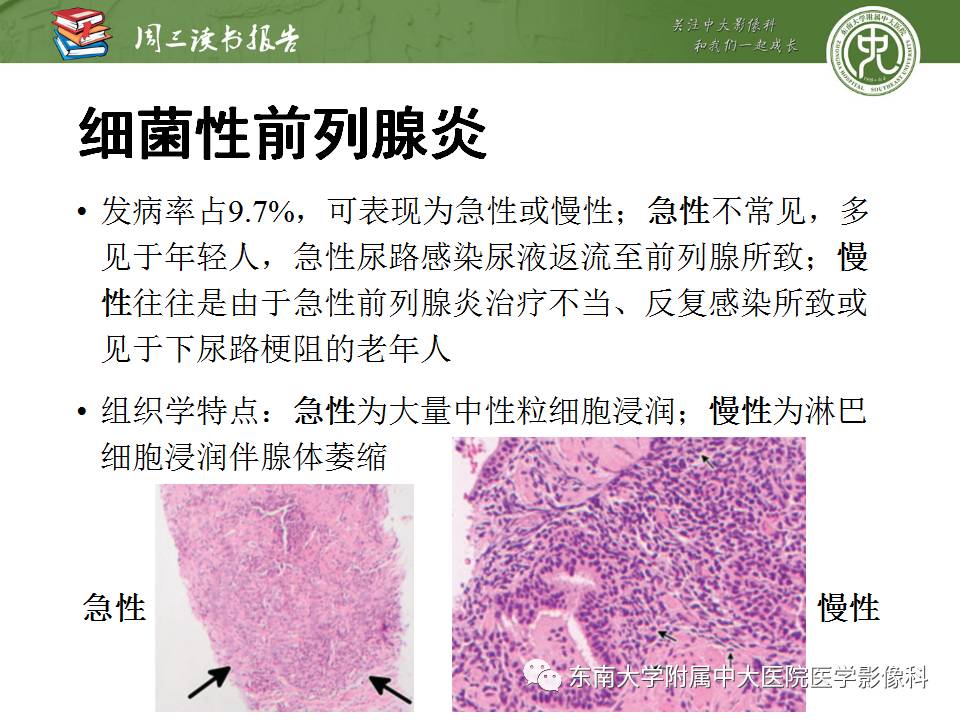 【PPT】MR易误诊为前列腺癌的良性表现：影像-病理相关性