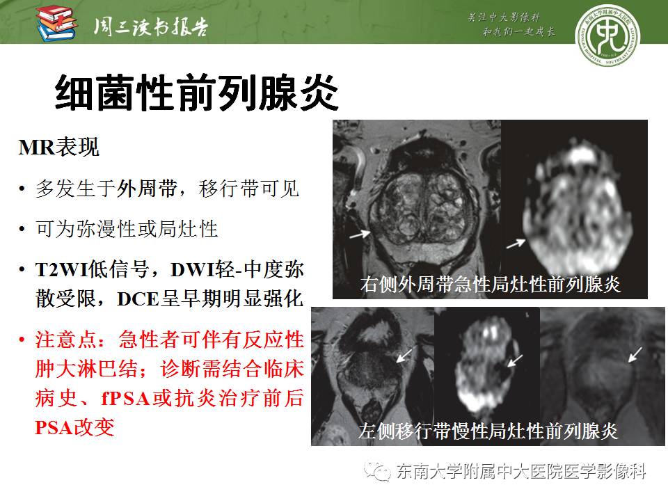 【PPT】MR易误诊为前列腺癌的良性表现：影像-病理相关性