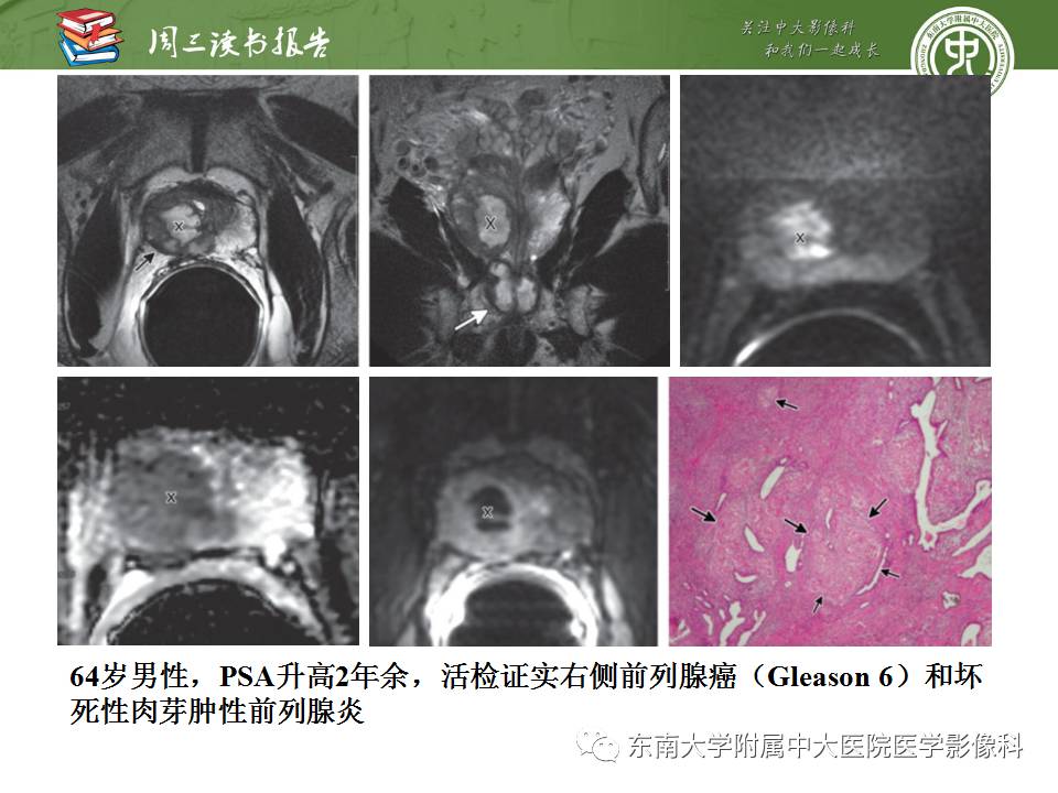 【PPT】MR易误诊为前列腺癌的良性表现：影像-病理相关性