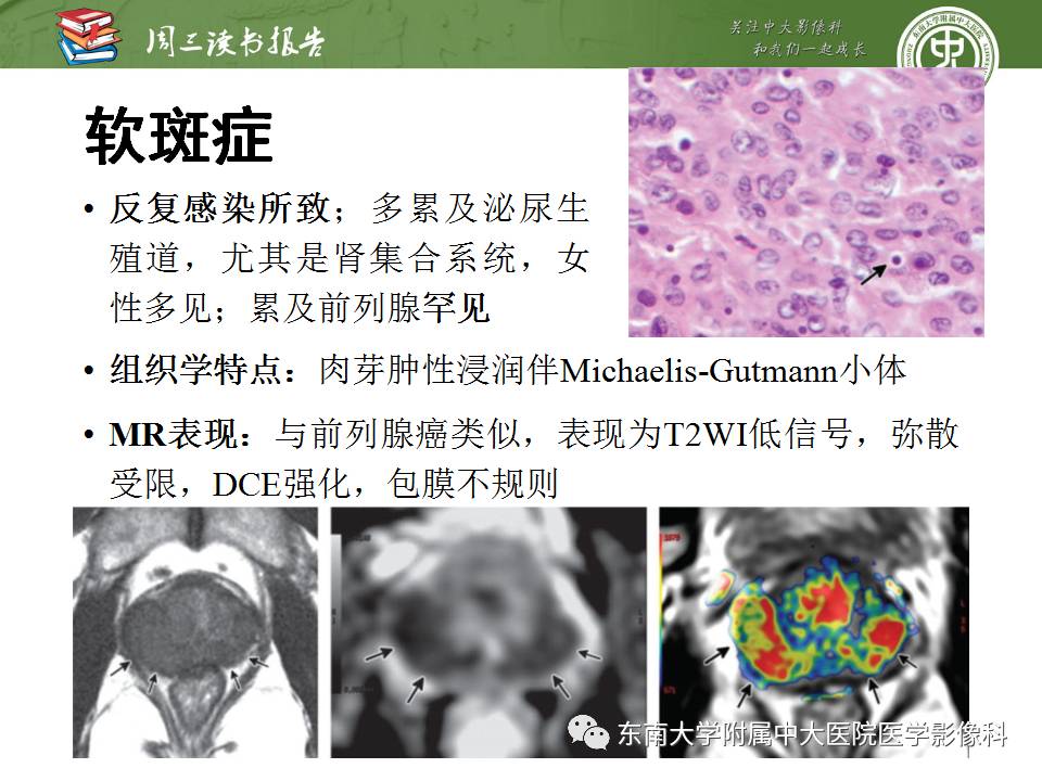 【PPT】MR易误诊为前列腺癌的良性表现：影像-病理相关性