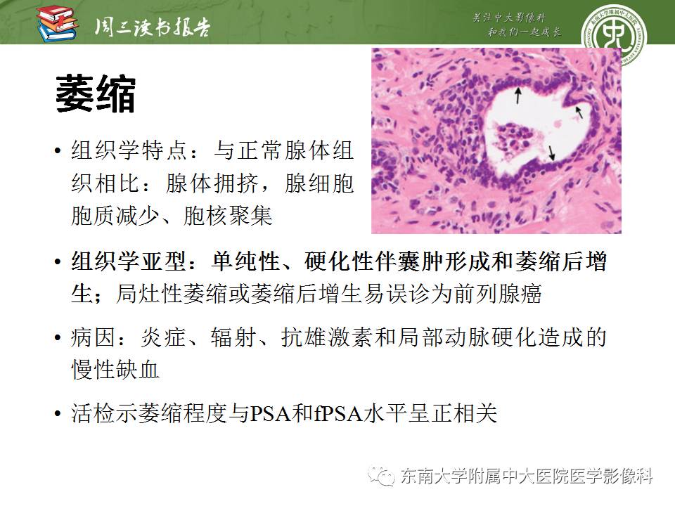【PPT】MR易误诊为前列腺癌的良性表现：影像-病理相关性