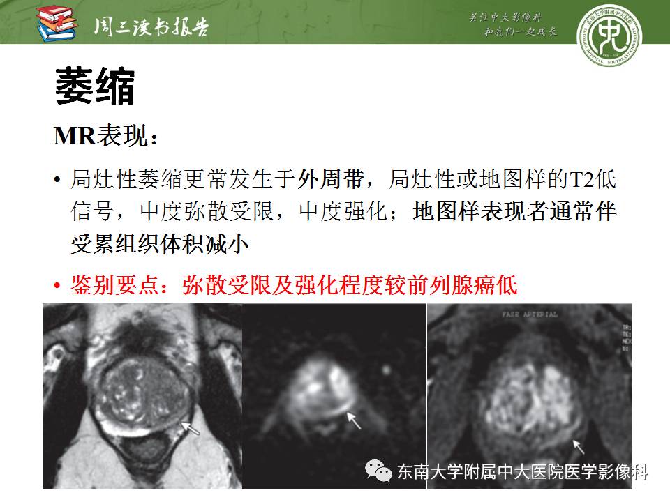 【PPT】MR易误诊为前列腺癌的良性表现：影像-病理相关性