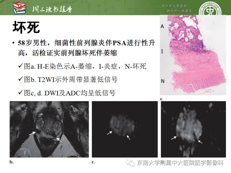 【PPT】MR易误诊为前列腺癌的良性表现：影像-病理相关性