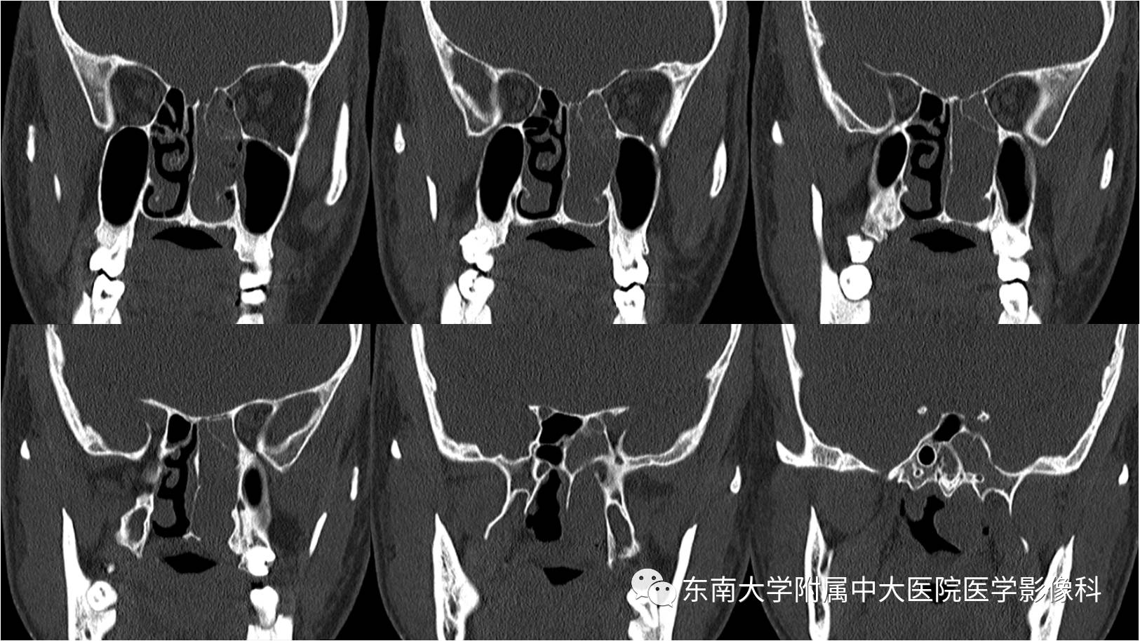 【病例】嗅神经母细胞瘤1例CT及MR影像表现