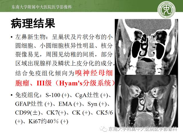 【病例】嗅神经母细胞瘤1例CT及MR影像表现