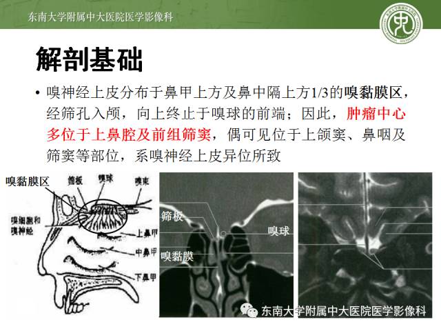 【病例】嗅神经母细胞瘤1例CT及MR影像表现