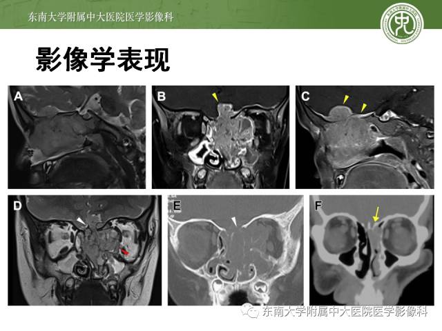 【病例】嗅神经母细胞瘤1例CT及MR影像表现