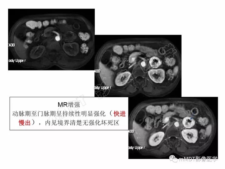 【PPT】腹膜后副神经节瘤影像诊断