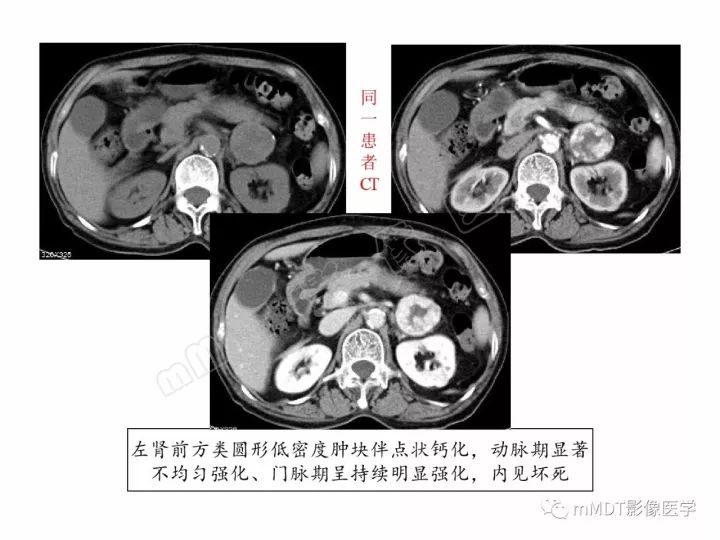 【PPT】腹膜后副神经节瘤影像诊断