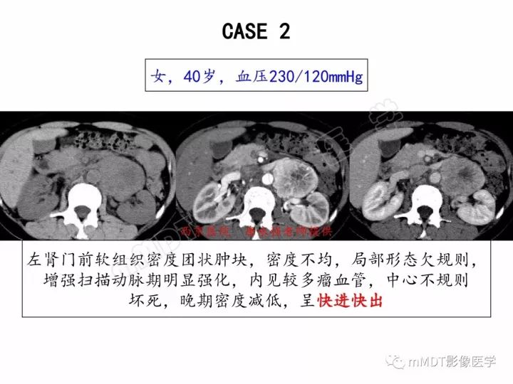 【PPT】腹膜后副神经节瘤影像诊断