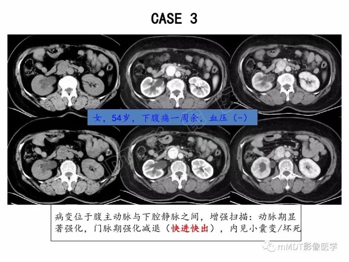 【PPT】腹膜后副神经节瘤影像诊断