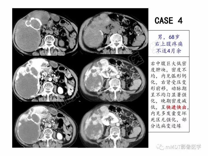 【PPT】腹膜后副神经节瘤影像诊断