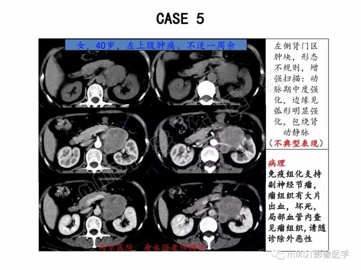 【PPT】腹膜后副神经节瘤影像诊断