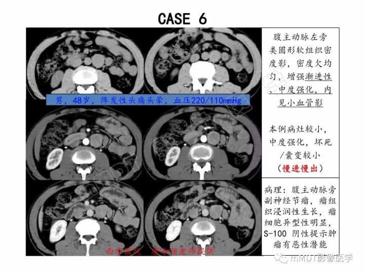 【PPT】腹膜后副神经节瘤影像诊断