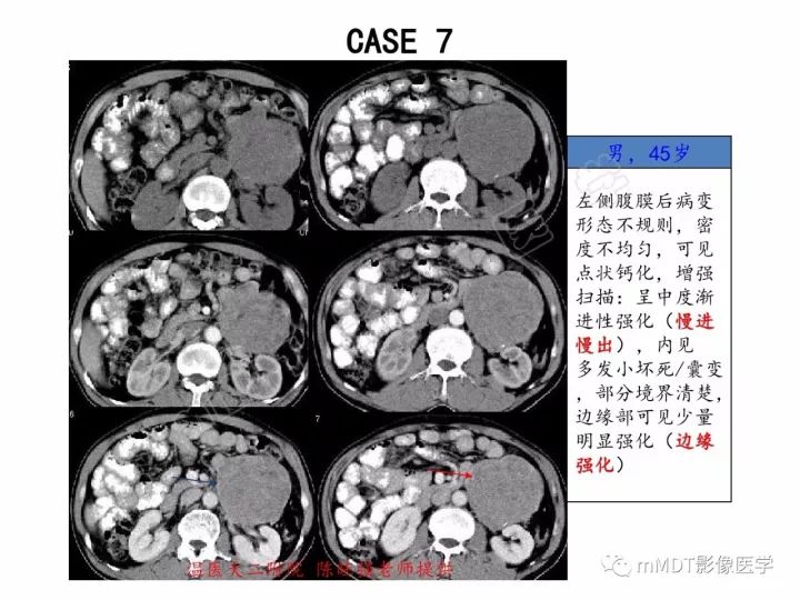 【PPT】腹膜后副神经节瘤影像诊断