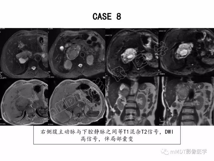 【PPT】腹膜后副神经节瘤影像诊断