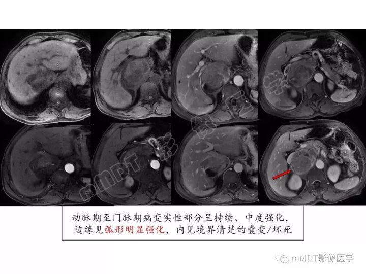 【PPT】腹膜后副神经节瘤影像诊断