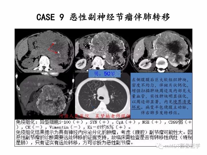 【PPT】腹膜后副神经节瘤影像诊断