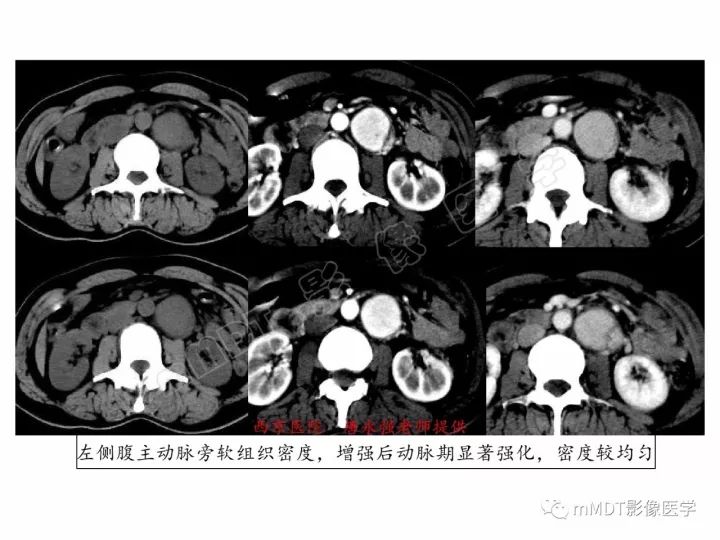 【PPT】腹膜后副神经节瘤影像诊断