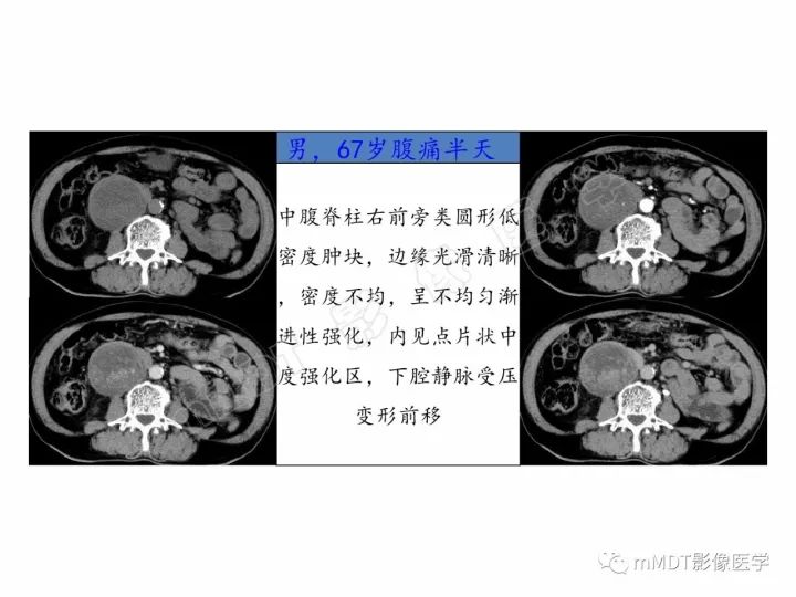 【PPT】腹膜后副神经节瘤影像诊断
