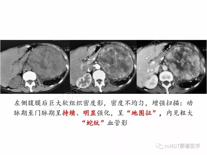 【PPT】腹膜后副神经节瘤影像诊断