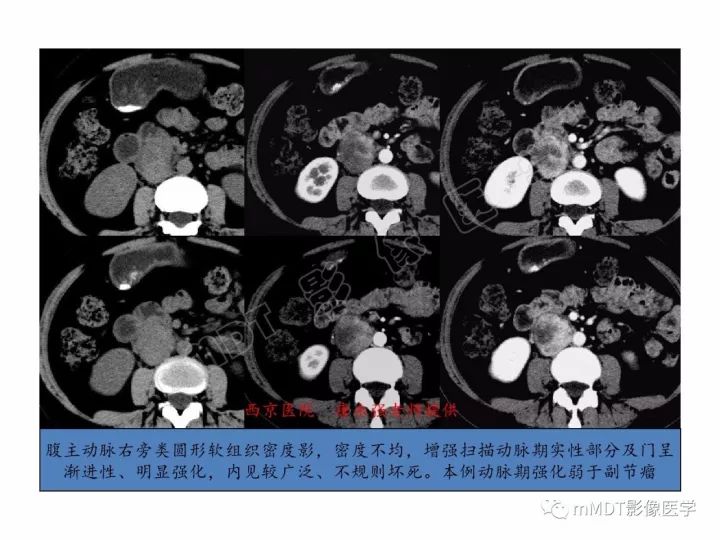 【PPT】腹膜后副神经节瘤影像诊断