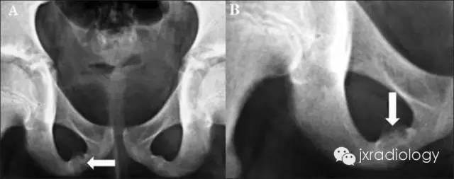 坐骨耻骨骨软骨病(Ischiopubic Synchondrosis) 坐骨耻骨骨软骨病(Ischiopubic Synchondrosis)