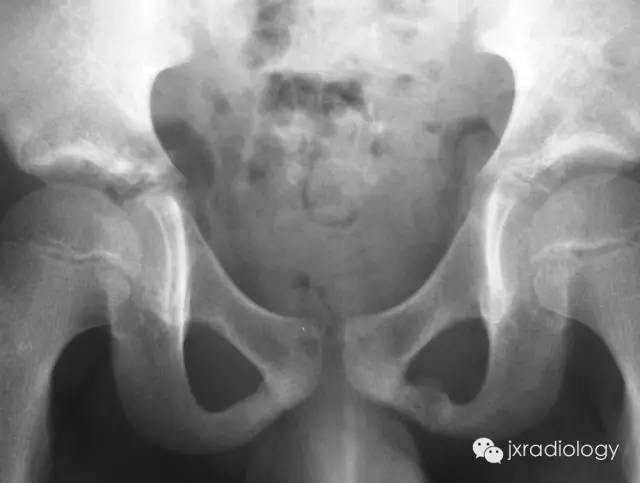 坐骨耻骨骨软骨病(Ischiopubic Synchondrosis) 坐骨耻骨骨软骨病(Ischiopubic Synchondrosis)