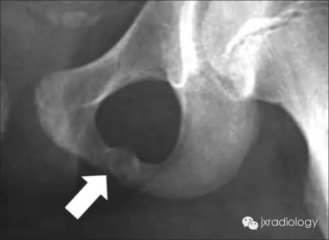 坐骨耻骨骨软骨病(Ischiopubic Synchondrosis) 坐骨耻骨骨软骨病(Ischiopubic Synchondrosis)