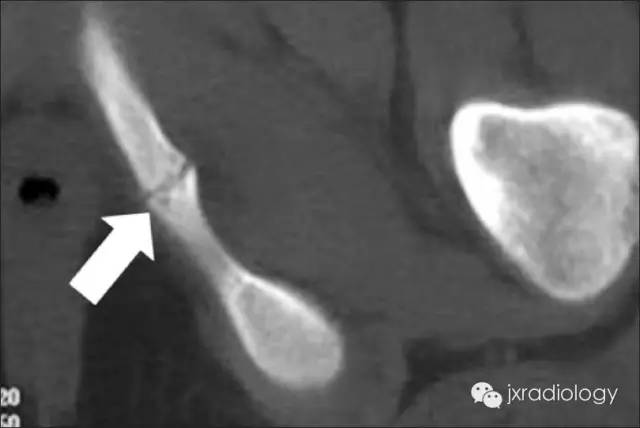 坐骨耻骨骨软骨病（Ischiopubic Synchondrosis）