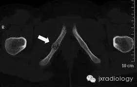 坐骨耻骨骨软骨病(Ischiopubic Synchondrosis) 坐骨耻骨骨软骨病(Ischiopubic Synchondrosis)