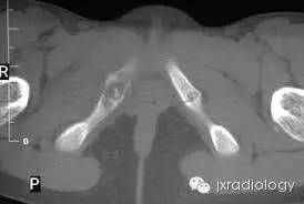 坐骨耻骨骨软骨病(Ischiopubic Synchondrosis) 坐骨耻骨骨软骨病(Ischiopubic Synchondrosis)