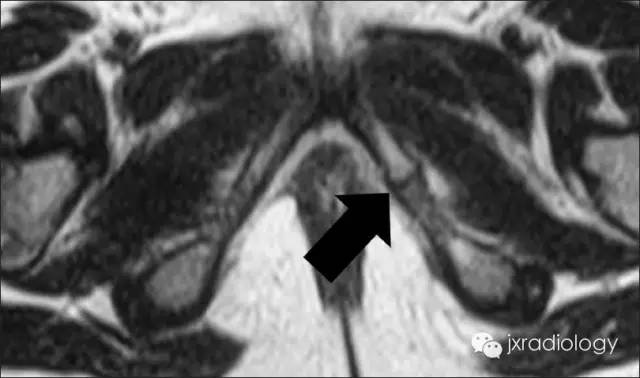 坐骨耻骨骨软骨病(Ischiopubic Synchondrosis) 坐骨耻骨骨软骨病(Ischiopubic Synchondrosis)