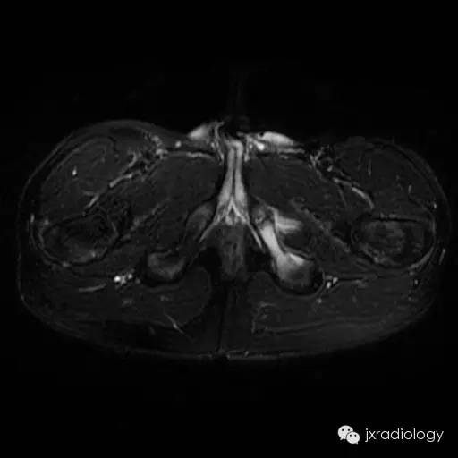坐骨耻骨骨软骨病(Ischiopubic Synchondrosis) 坐骨耻骨骨软骨病(Ischiopubic Synchondrosis)