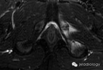 坐骨耻骨骨软骨病(Ischiopubic Synchondrosis) 坐骨耻骨骨软骨病(Ischiopubic Synchondrosis)