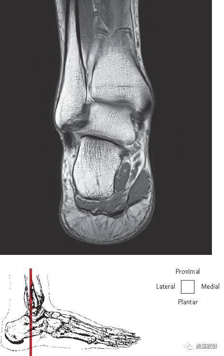 踝关节系统解剖图+冠/矢/轴MRI 踝关节系统解剖图+冠/矢/轴MRI