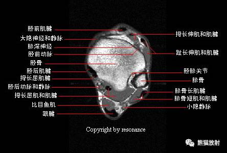 踝关节系统解剖图+冠/矢/轴MRI 踝关节系统解剖图+冠/矢/轴MRI