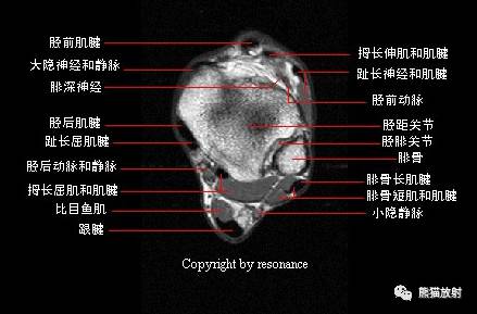 踝关节系统解剖图+冠/矢/轴MRI 踝关节系统解剖图+冠/矢/轴MRI