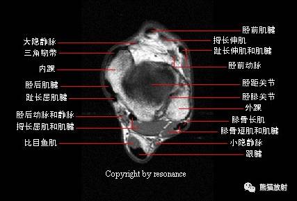 踝关节系统解剖图+冠/矢/轴MRI 踝关节系统解剖图+冠/矢/轴MRI