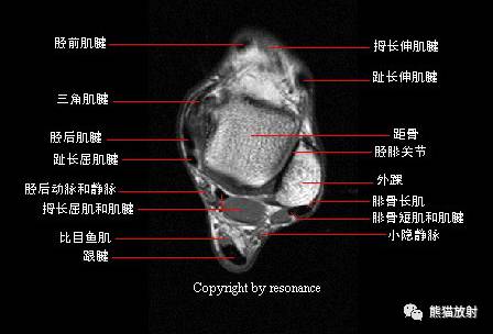踝关节系统解剖图+冠/矢/轴MRI 踝关节系统解剖图+冠/矢/轴MRI
