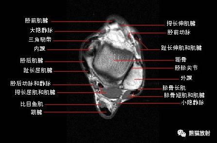 踝关节系统解剖图+冠/矢/轴MRI 踝关节系统解剖图+冠/矢/轴MRI