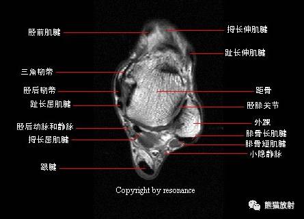 踝关节系统解剖图+冠/矢/轴MRI 踝关节系统解剖图+冠/矢/轴MRI
