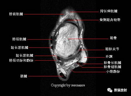 踝关节系统解剖图+冠/矢/轴MRI 踝关节系统解剖图+冠/矢/轴MRI