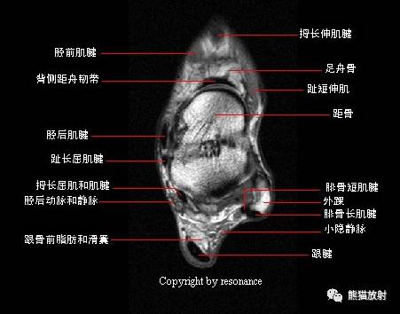 踝关节系统解剖图+冠/矢/轴MRI 踝关节系统解剖图+冠/矢/轴MRI