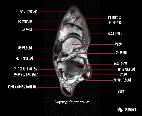 踝关节系统解剖图+冠/矢/轴MRI 踝关节系统解剖图+冠/矢/轴MRI