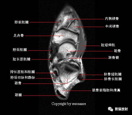 踝关节系统解剖图+冠/矢/轴MRI 踝关节系统解剖图+冠/矢/轴MRI