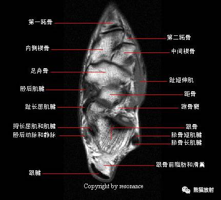 踝关节系统解剖图+冠/矢/轴MRI 踝关节系统解剖图+冠/矢/轴MRI