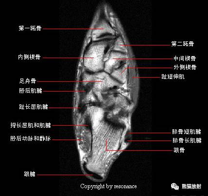 踝关节系统解剖图+冠/矢/轴MRI 踝关节系统解剖图+冠/矢/轴MRI