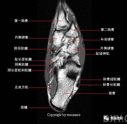 踝关节系统解剖图+冠/矢/轴MRI 踝关节系统解剖图+冠/矢/轴MRI