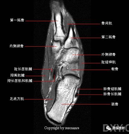 踝关节系统解剖图+冠/矢/轴MRI 踝关节系统解剖图+冠/矢/轴MRI